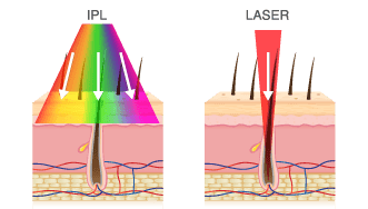 IPL Laser Diagram