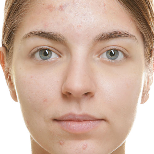 Acne before treatment