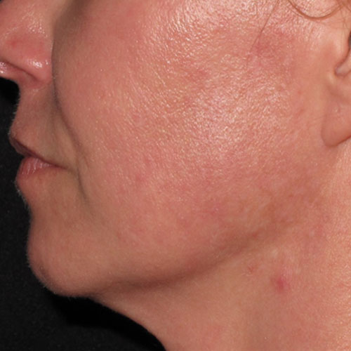 acne laser therapy after