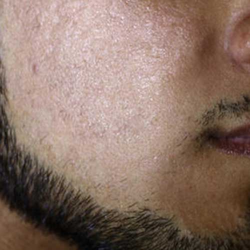 co2 laser acne scarring after