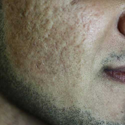 Co2 Laser Acne Scarring Before