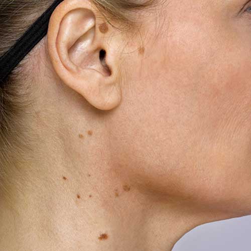 Age Spots Treatment Dermatology Center Of Newport