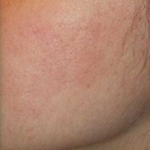 Genius Laser Acne Scarring After