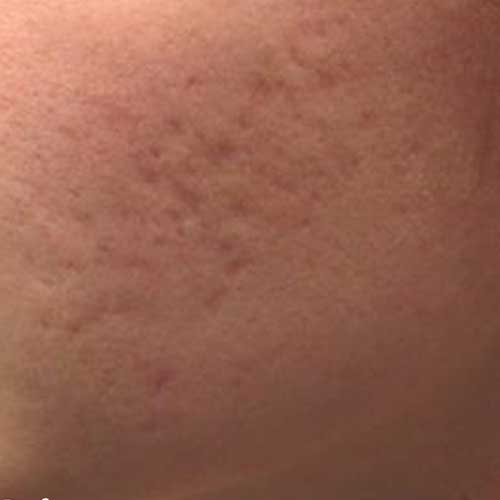 Genius Laser Acne Scarring Before