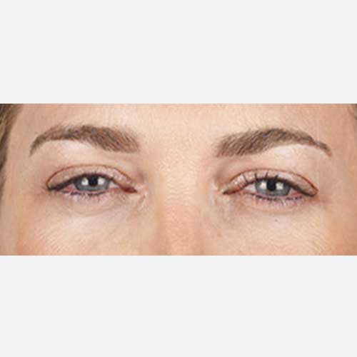 Xeomin Brow Lines After