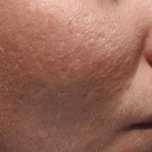 after acne scar removal