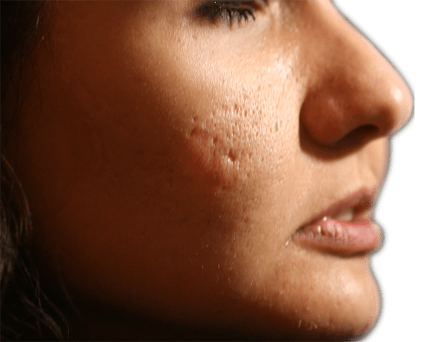 Bellafill acne scars