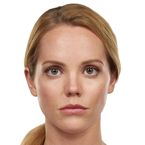 Juvederm After