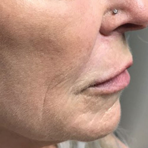 co2 mixto laser - right side of face after